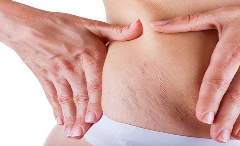 C:\Users\hp\Desktop\What is skin crack or striae.jpg